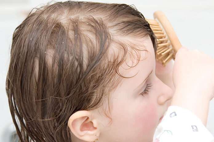 How to treat dandruff for children? - TechKunda